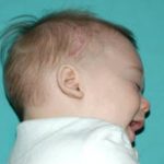 Craniosynostosis Before & After Patient #1580