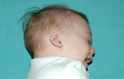 Craniosynostosis Before & After Patient #1580