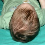 Craniosynostosis Before & After Patient #1580