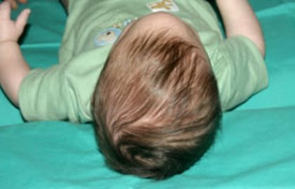 Craniosynostosis Before & After Patient #1580