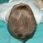 Craniosynostosis Before & After Patient #1580