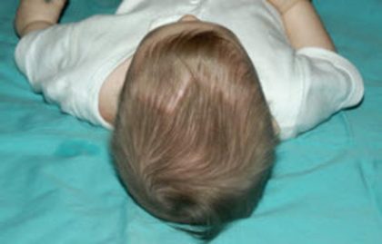 Craniosynostosis Before & After Patient #1580