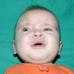 Craniosynostosis Before & After Patient #1581