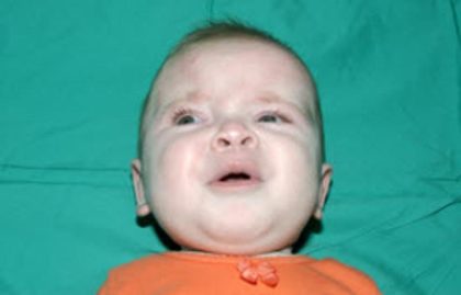 Craniosynostosis Before & After Patient #1581