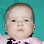 Craniosynostosis Before & After Patient #1581