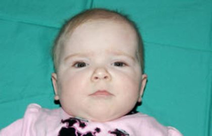 Craniosynostosis Before & After Patient #1581