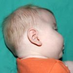 Craniosynostosis Before & After Patient #1581