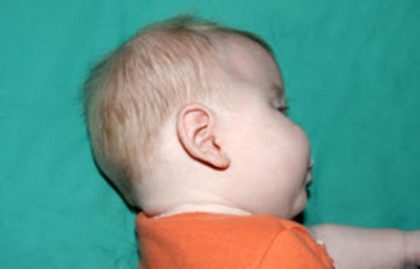 Craniosynostosis Before & After Patient #1581