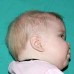 Craniosynostosis Before & After Patient #1581