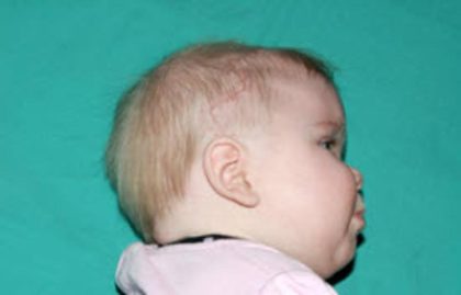 Craniosynostosis Before & After Patient #1581