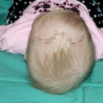 Craniosynostosis Before & After Patient #1581