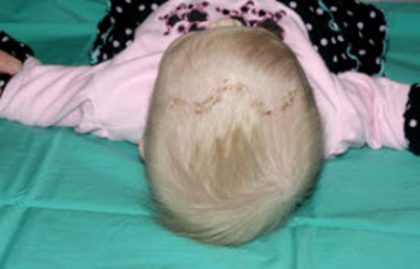 Craniosynostosis Before & After Patient #1581