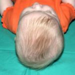 Craniosynostosis Before & After Patient #1581