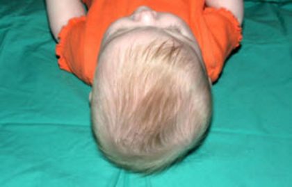 Craniosynostosis Before & After Patient #1581