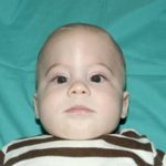 Craniosynostosis Before & After Patient #1582