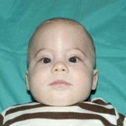 Craniosynostosis Before & After Patient #1582