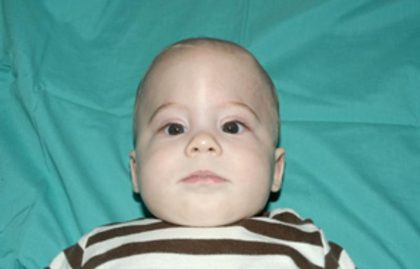 Craniosynostosis Before & After Patient #1582