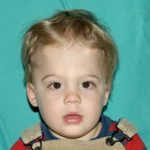 Craniosynostosis Before & After Patient #1582