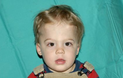Craniosynostosis Before & After Patient #1582