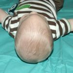 Craniosynostosis Before & After Patient #1582