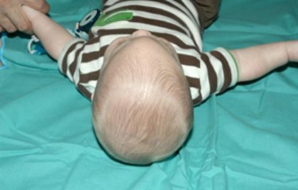 Craniosynostosis Before & After Patient #1582