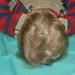 Craniosynostosis Before & After Patient #1582