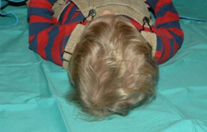 Craniosynostosis Before & After Patient #1582