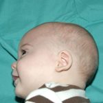 Craniosynostosis Before & After Patient #1582