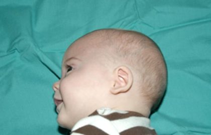 Craniosynostosis Before & After Patient #1582