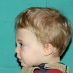 Craniosynostosis Before & After Patient #1582