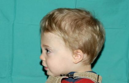 Craniosynostosis Before & After Patient #1582