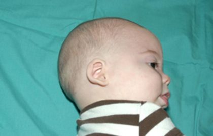 Craniosynostosis Before & After Patient #1582