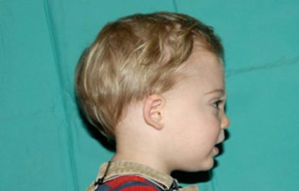 Craniosynostosis Before & After Patient #1582