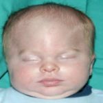 Craniosynostosis Before & After Patient #1583
