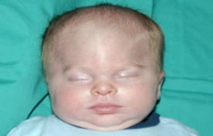 Craniosynostosis Before & After Patient #1583