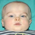 Craniosynostosis Before & After Patient #1583