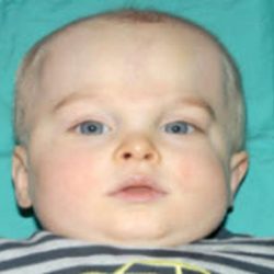 Craniosynostosis Before & After Patient #1583
