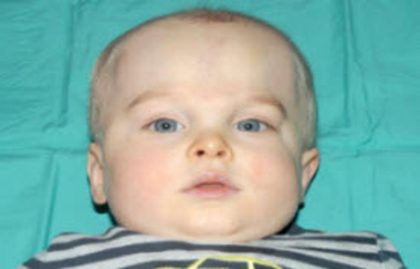 Craniosynostosis Before & After Patient #1583