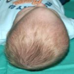 Craniosynostosis Before & After Patient #1583