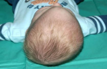 Craniosynostosis Before & After Patient #1583
