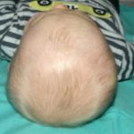 Craniosynostosis Before & After Patient #1583