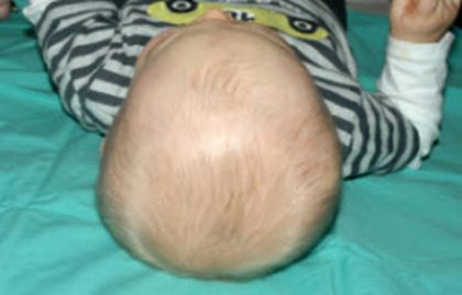 Craniosynostosis Before & After Patient #1583