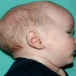 Craniosynostosis Before & After Patient #1584