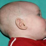 Craniosynostosis Before & After Patient #1584