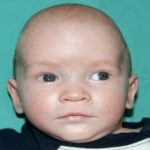 Craniosynostosis Before & After Patient #1584