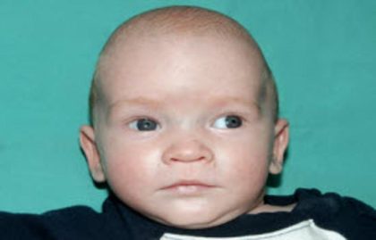 Craniosynostosis Before & After Patient #1584