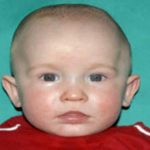 Craniosynostosis Before & After Patient #1584