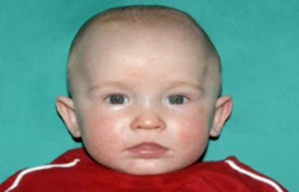 Craniosynostosis Before & After Patient #1584