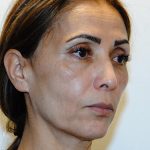 Eyebrow lift Before & After Patient #1585
