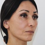 Eyebrow lift Before & After Patient #1585